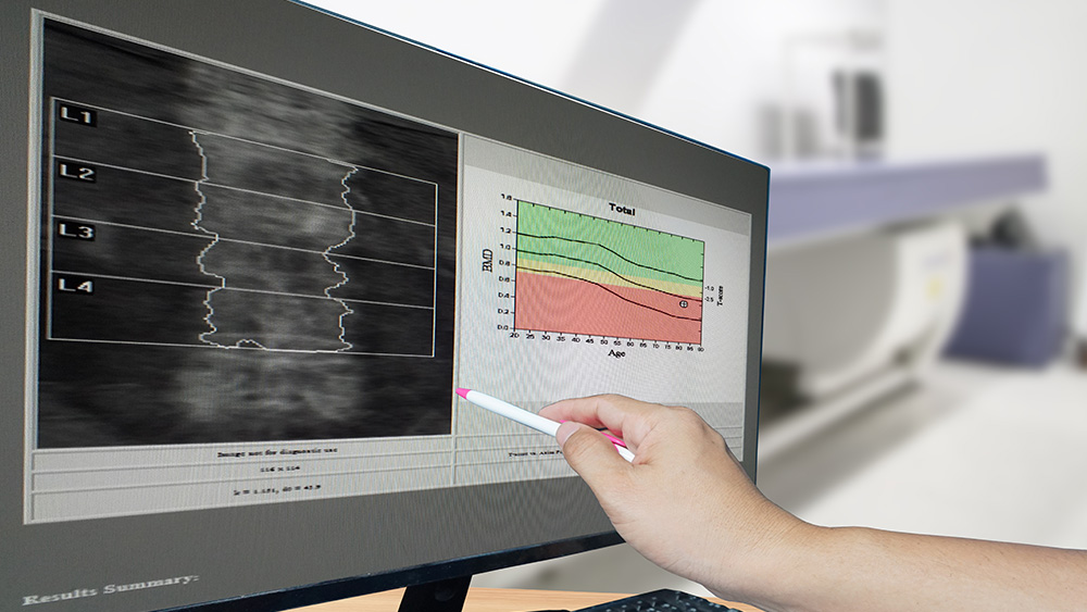 Bone Density Test for detecting Osteopenia